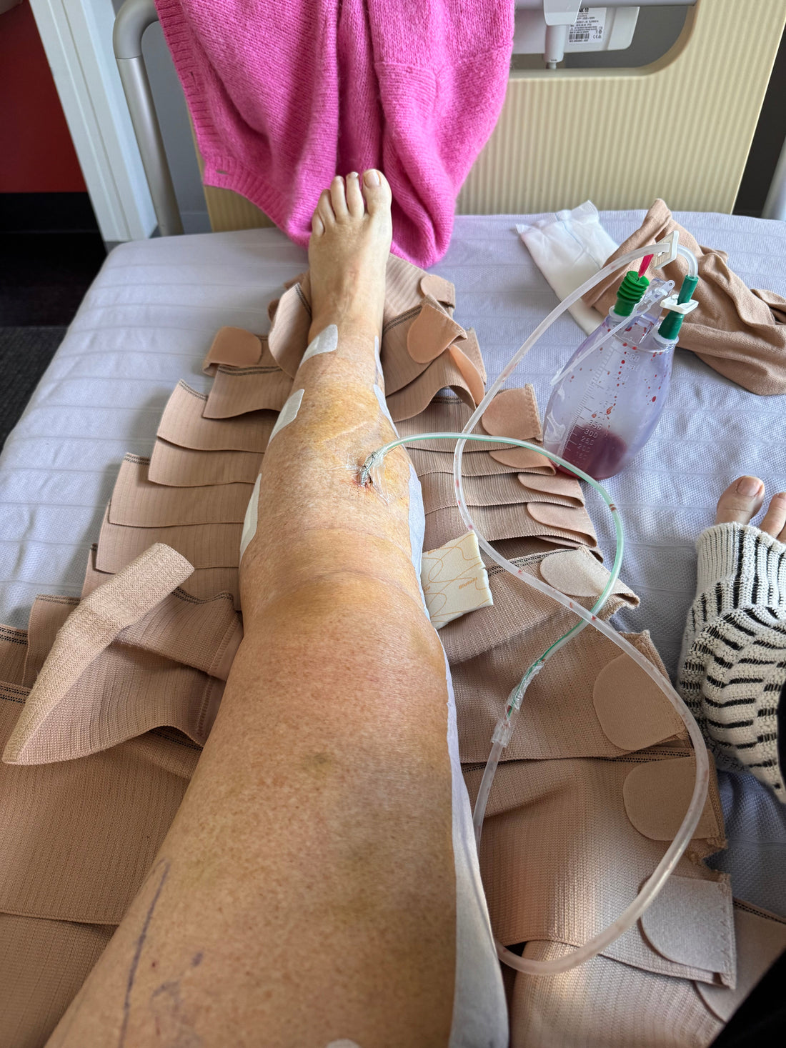 Kate's personal lipoedema surgery journey and recovery