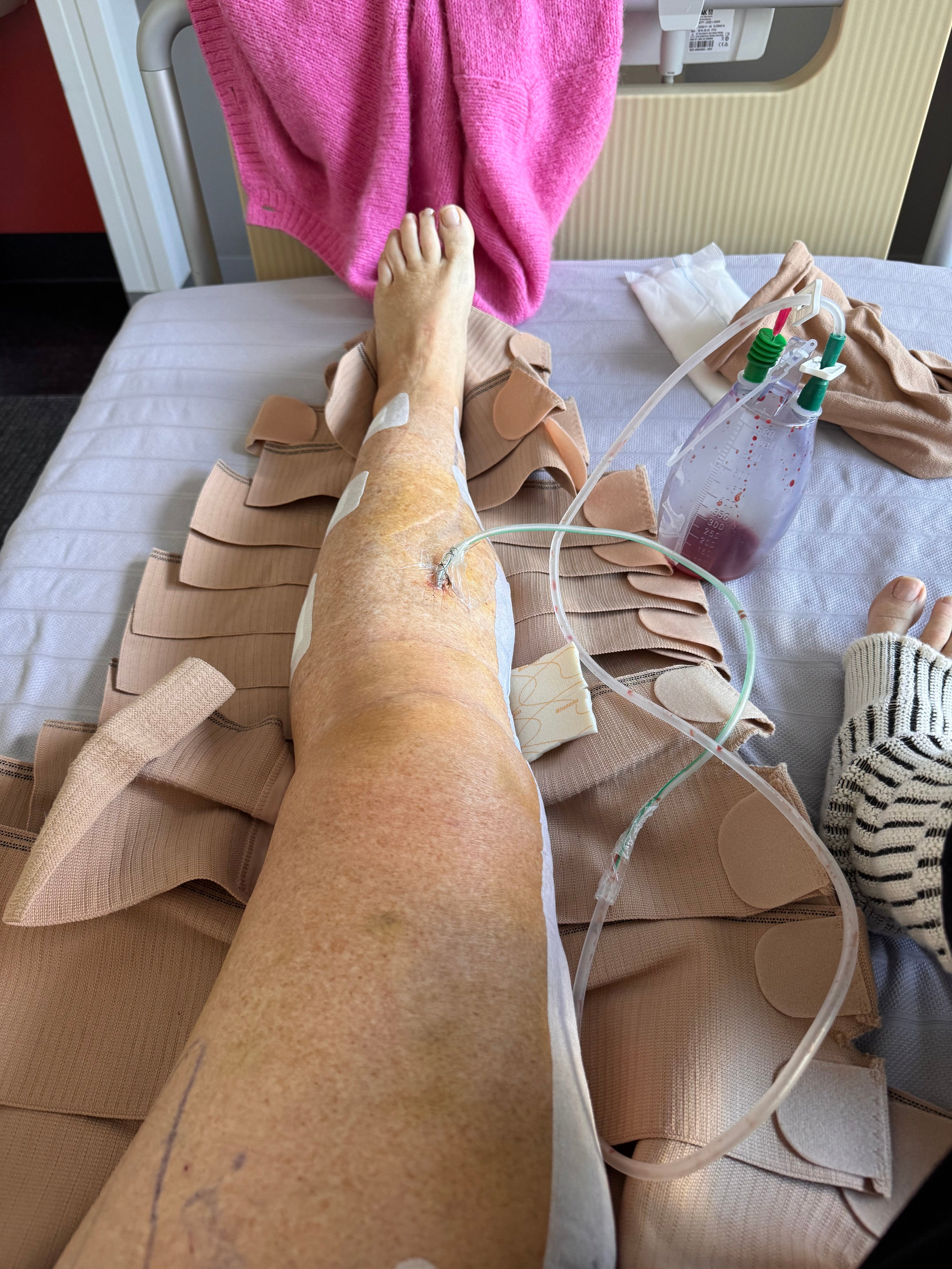 Kate's personal lipoedema surgery journey and recovery